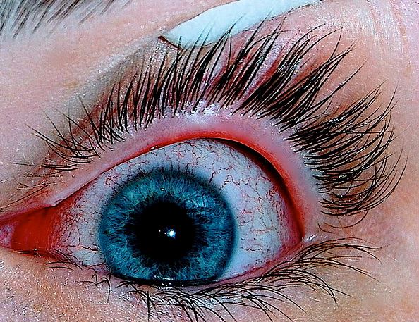 Diseases related to eyes in German